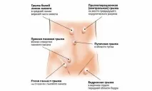 Лікування грижі за кордоном, Операції при лікуванні грижі за кордоном грижі