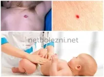 Дрібні червоні крапки на тілі як родимки, причини появи родимки