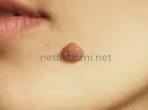 Дрібні червоні крапки на тілі як родимки, причини появи червоні