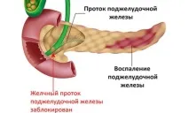 панкреатиту