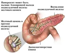 загострення