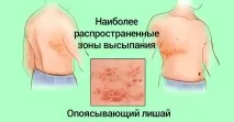 лікування