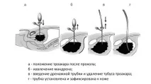 Операція троакарної цистостомії – показання, проведення та подальший догляд операція