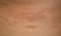 симптоми