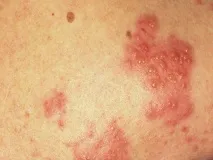 симптоми