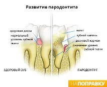 Пародонтит симптоми та лікування. пародонтит