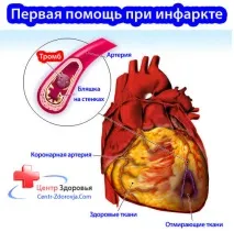 Перша допомога при інфаркті, Сайт лікаря Літакової Д сайт
