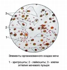 Нирковий епітелій у сечі - що це означає, причини, лікування - Інфо сечі