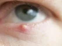 Чому у дитини червоні очі та гнояться, що робити чому