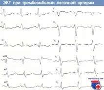 Ознаки ТЕЛА (тромбоемболії легеневої артерії, гострого легеневого серця) на ЕКГ тела