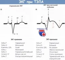 Ознаки ТЕЛА (тромбоемболії легеневої артерії, гострого легеневого серця) на ЕКГ легеневої
