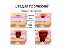 Пролежні у лежачих хворих лікування в домашніх умовах, ефективні засоби від пролежнів домашніх