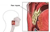 Рак гортані ознаки та симптоми, чи можна вилікувати симптоми
