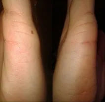 Родимка на лінії шлюбу лінії