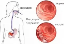 Крок за кроком ефективне лікування гастриту крок
