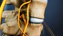 Спондильоз причини, симптоми, лікування може