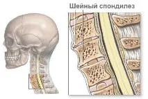 Спондильоз причини, симптоми, лікування спондильоз