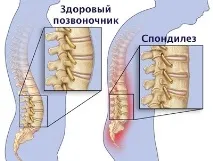 Спондильоз причини, симптоми, лікування лікування