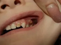 Свищ на яснах симптоми, причини появи, як лікувати недугу яснах