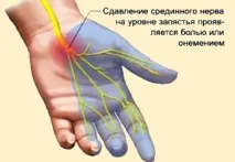 Тунельні синдроми верхньої кінцівки симптоми та лікування тунельні