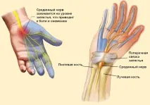 Тунельні синдроми верхньої кінцівки симптоми та лікування тунельні