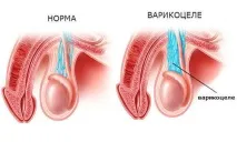 Варикоцеле який наркоз роблять під час операції який