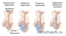 Водянка яєчка може призвести до безпліддя, Проблеми чоловічого та жіночого безпліддя та методи їх вирішення водянка