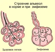 Хобл, емфізема, астма емфізема