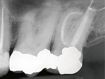 Препарування додаткового медіального щічного каналу одним інструментом – Dental Magazine медіального