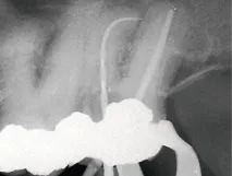 Препарування додаткового медіального щічного каналу одним інструментом – Dental Magazine медіального