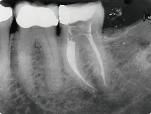 Препарування додаткового медіального щічного каналу одним інструментом – Dental Magazine препарування