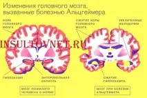 Хвороба Альцгеймера - подробиці про страшну недугу хвороба