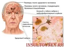 Хвороба Альцгеймера - подробиці про страшну недугу страшну