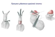 циркумцизія