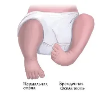 Діагностика та лікування клишоногості у дітей клишоногості