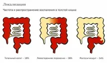 Дієта при коліті кишечника з діареєю, запорами та здуттям живота зразкове меню діареєю