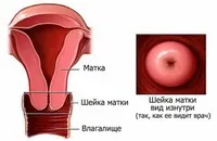 Ерозія шийки матки – що це матки