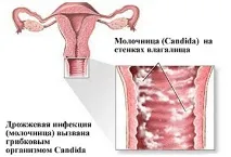 Олена Малишева - Ефективний засіб для лікування молочниці ефективний