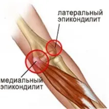 Епікондиліт лікування лікування