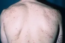 симптоми