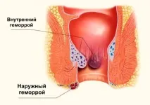 Геморой у чоловіків види, причини, симптоми, діагностика, лікування та профілактика причини