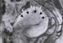 Гіперплазія аденоміозу два шляхи розвитку гіперплазія