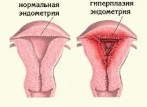 Гіперплазія у гінекології ендометрію