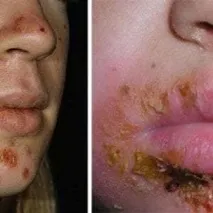 шкірні
