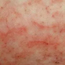 захворювання