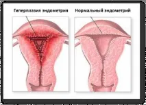 Лікування гіперплазії ендометрію в менопаузі та при клімаксі ендометрію