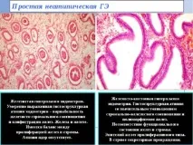 Лікування гіперплазії ендометрію в менопаузі та при клімаксі менопаузі