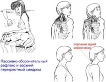 М’яз антисутулості - ромбоподібний - Сергій Груздєв ромбоподібний