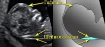 Норми УЗД та скринінг триместру аналіз, розшифровка, 1 та 2 триместр скринінг