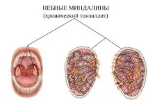 Небезпека вузлів у щитовидці та заходи щодо їх усунення у 2019 році усунення